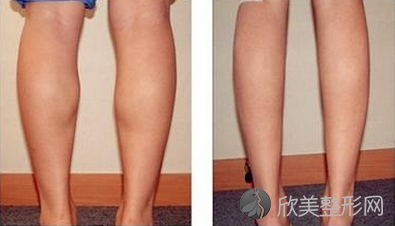 小腿吸脂都有哪些手术种类及不同效果