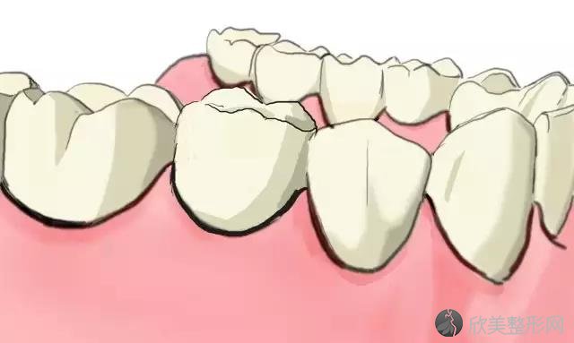 手绘图文为您讲解：传统镶牙和种植牙的区别