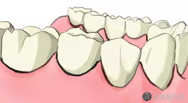 手绘图文为您讲解：传统镶牙和种植牙的区别