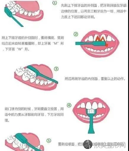 史上较详细的种植牙流程