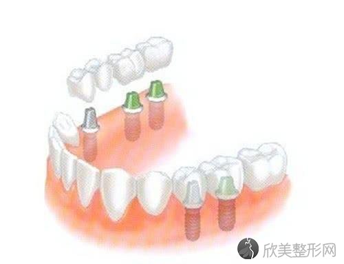 什么叫种植牙齿？种植牙有什么好处？有什么危害？
