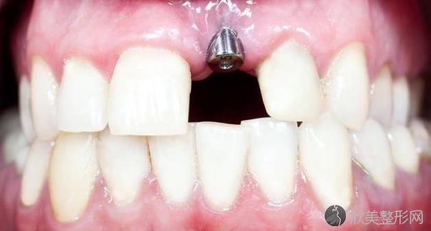 越来越多人做种植牙？医生：种植牙这3大好处被不少人认同！