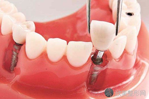 有哪些常见的种植牙齿类型？