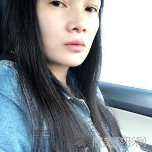 北医三院李东隆鼻怎么样?自体脂肪面部填充三个月术前术后图-价格表更新