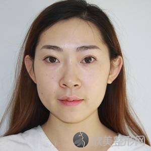 北医三院潘柏林兔唇修复怎么样?面部吸脂价格表-术前术后图