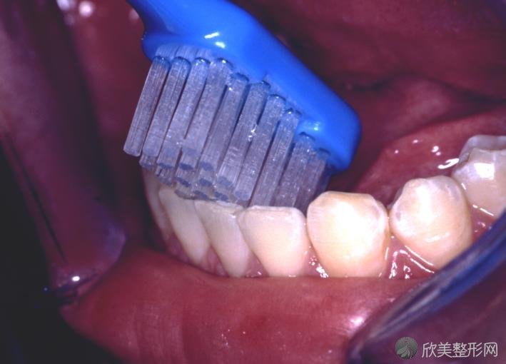 想要彻底清洁牙齿该怎么做？