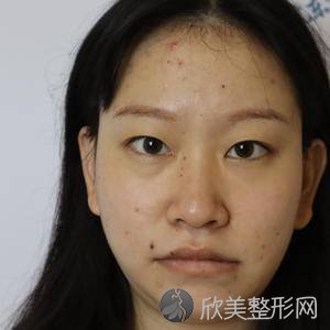 北医三院赵润蕾面部填充怎么样?双眼皮案例反馈-收费标准