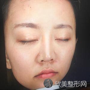北医三院赵旬光子嫩肤怎么样?玻尿酸面部填充顾客术后反馈案例-收费标准