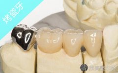 烤瓷牙分为哪些种类，怎么选择适合自己的烤瓷牙？