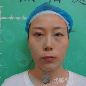 北医三院整形科张颂怎么样?自体脂肪面部填充顾客反馈案例-收费标准