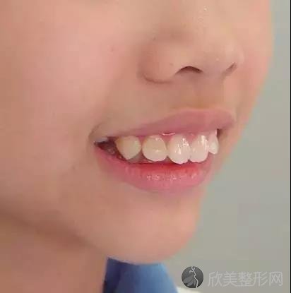 这20种儿童牙颌畸形12岁前必须处理!