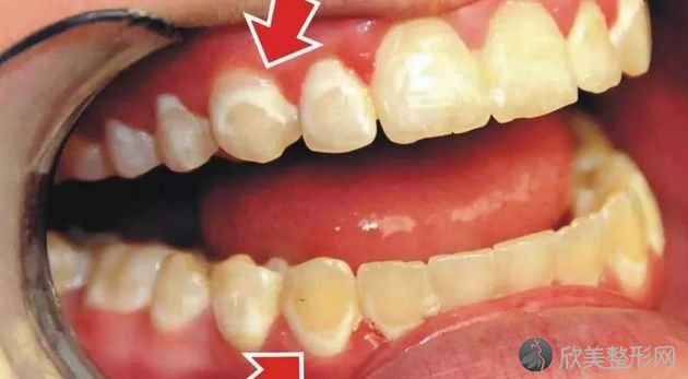牙齿矫正期间，怎么有效的做好清洁？