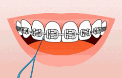 牙齿矫正期间，怎么有效的做好清洁？