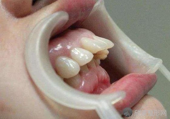 牙齿矫正的这几个步骤，你知道吗？