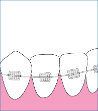 牙齿矫正期间该如何刷牙？