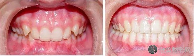 牙齿深覆合不进行矫正会有什么危害呢？