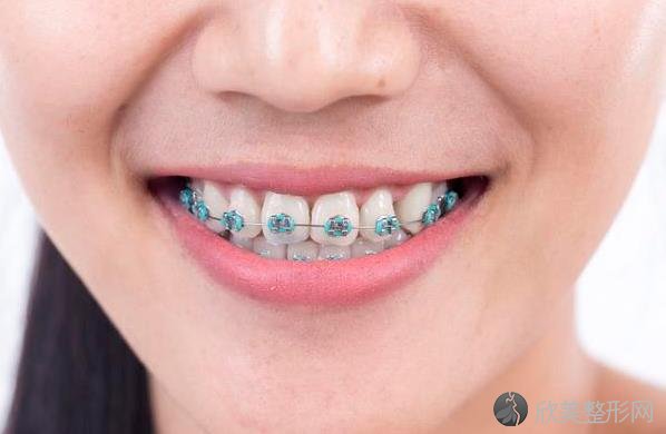 牙齿整齐不代表咬合正常，有这些咬合问题的人建议尽早矫正！