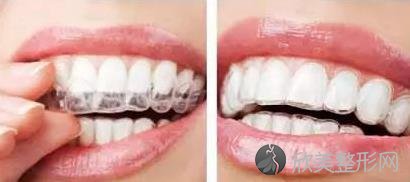 牙齿整齐不代表咬合正常，有这些咬合问题的人建议尽早矫正！