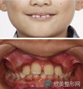 “龅牙”一定要等到换完牙再开始矫正吗？