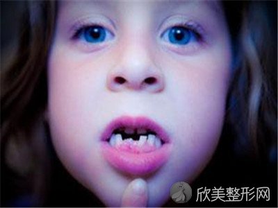 mrc矫正器和罗慕区别有哪些？儿童矫正牙齿较佳时间？