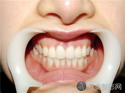 牙套可以纠正牙齿吗？牙齿畸形怎么矫正
