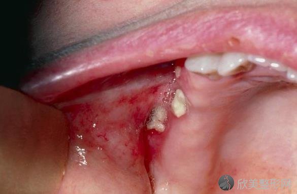 牙周炎会引发4种疾病！