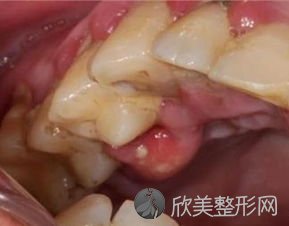 牙周炎有什么特点，牙周炎有哪些特别的表现？