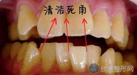 你知道牙齿不齐的危害吗？