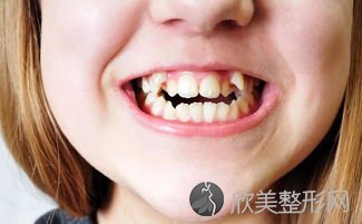 龅牙是由哪些原因造成的呢？