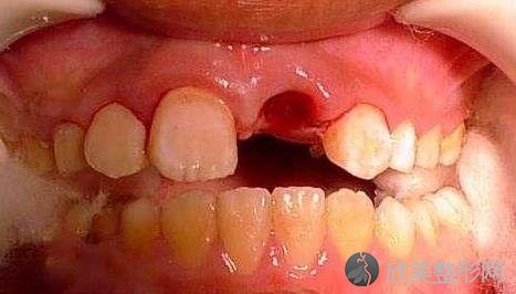 牙齿意外脱落还能再种回去吗？这些措施得先做到，看看你符合吗？