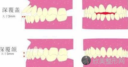 4种常见的牙齿不齐浅析！
