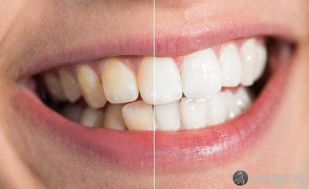 美白牙齿会有伤害吗？普遍的2种美白方式，各有优劣！