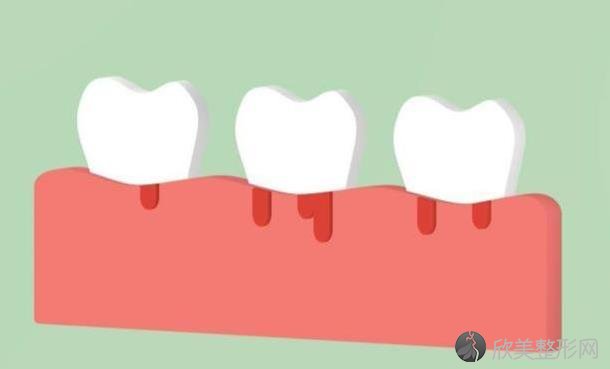 牙齿一吸就出血是癌症？不至于，但若是这3种，就不得不重视了！