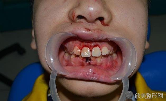 牙齿外伤脱落后如何急救，99%的人都做错了！