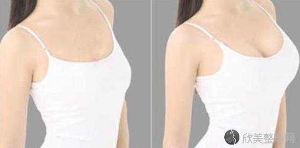 假体隆胸VS自体脂肪隆胸，你更适合哪一种呢？