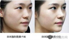 自体脂肪隆鼻怎么样？