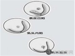 乳头异样整形价格