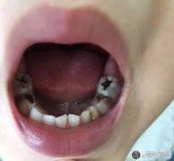 窝沟封闭没效果？这5个误区让窝沟封闭失效！