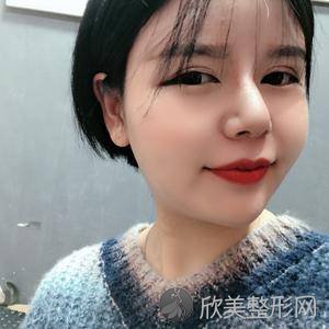 成都米兰柏羽陈倩做鼻子怎么样?颧骨颧弓整形术术前术后图