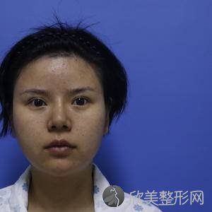 成都米兰柏羽陈倩做鼻子怎么样?颧骨颧弓整形术术前术后图