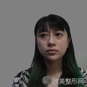 成美整形医院王立鹏怎么样?自体脂肪面部填充附上医生案例及价格表一览