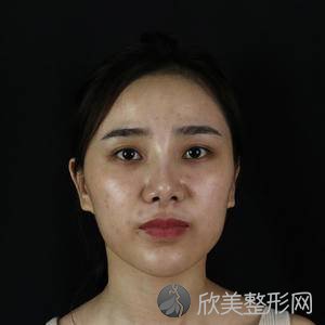 广东韩妃医疗美容医院黄蔚医生怎么样?吸脂瘦脸术后三个月真实野生反馈