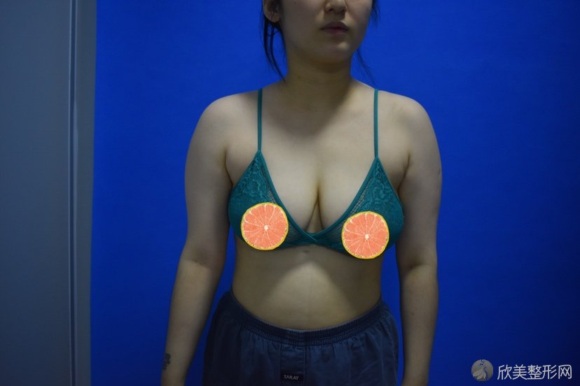 广西哪家医院做吸脂去副乳手术较好？排行榜德亚、老贵族男士整容、梧州人民