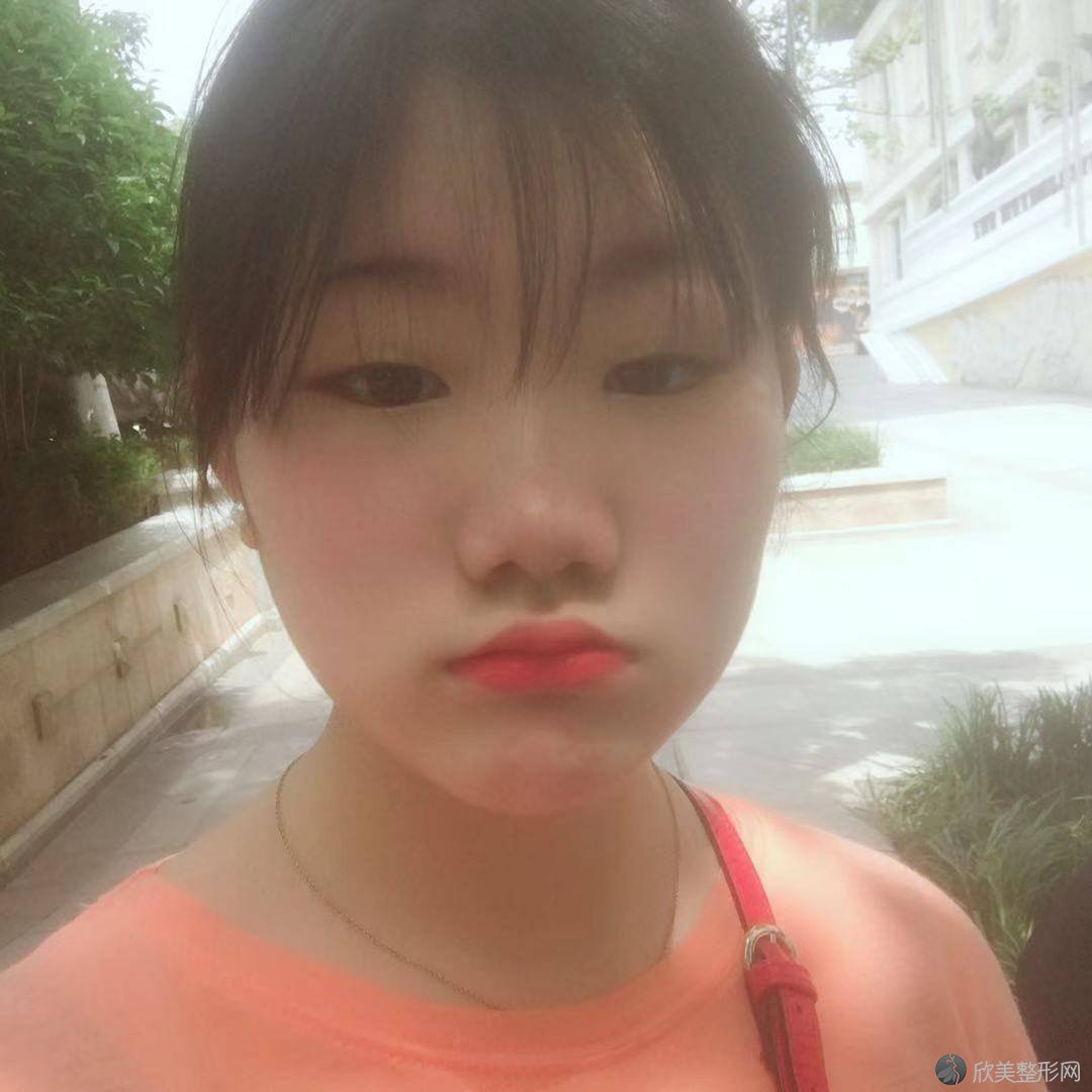 南通康美国际整形美容医院夏尧龙做吸脂怎么样？附医生简介-吸脂案例及价格