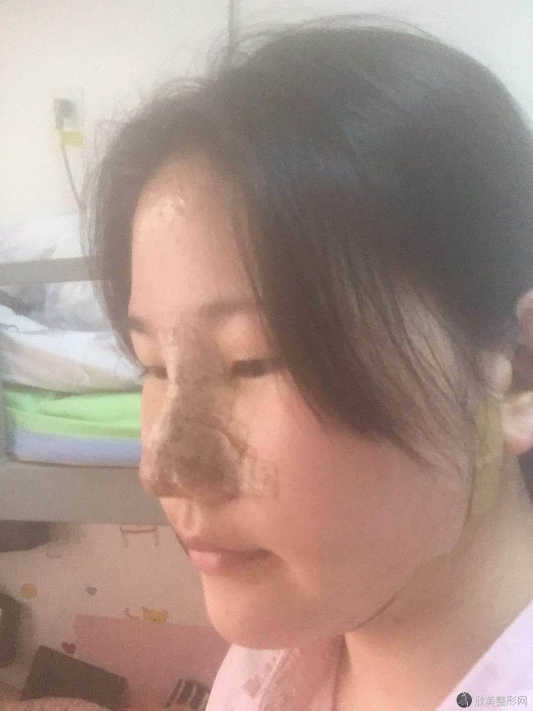 南通康美国际整形美容医院夏尧龙做吸脂怎么样？附医生简介-吸脂案例及价格