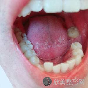 乌鲁木齐医疗整形医院赵小忠做牙齿种植怎么样？附医生简介-牙齿种植案例及