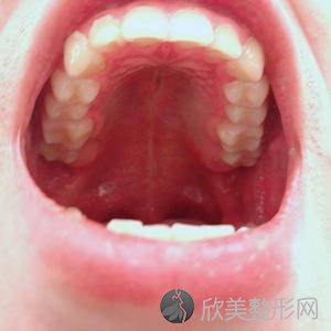 乌鲁木齐医疗整形医院赵小忠做牙齿种植怎么样？附医生简介-牙齿种植案例及