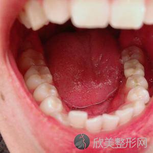 乌鲁木齐医疗整形医院赵小忠做牙齿种植怎么样？附医生简介-牙齿种植案例及