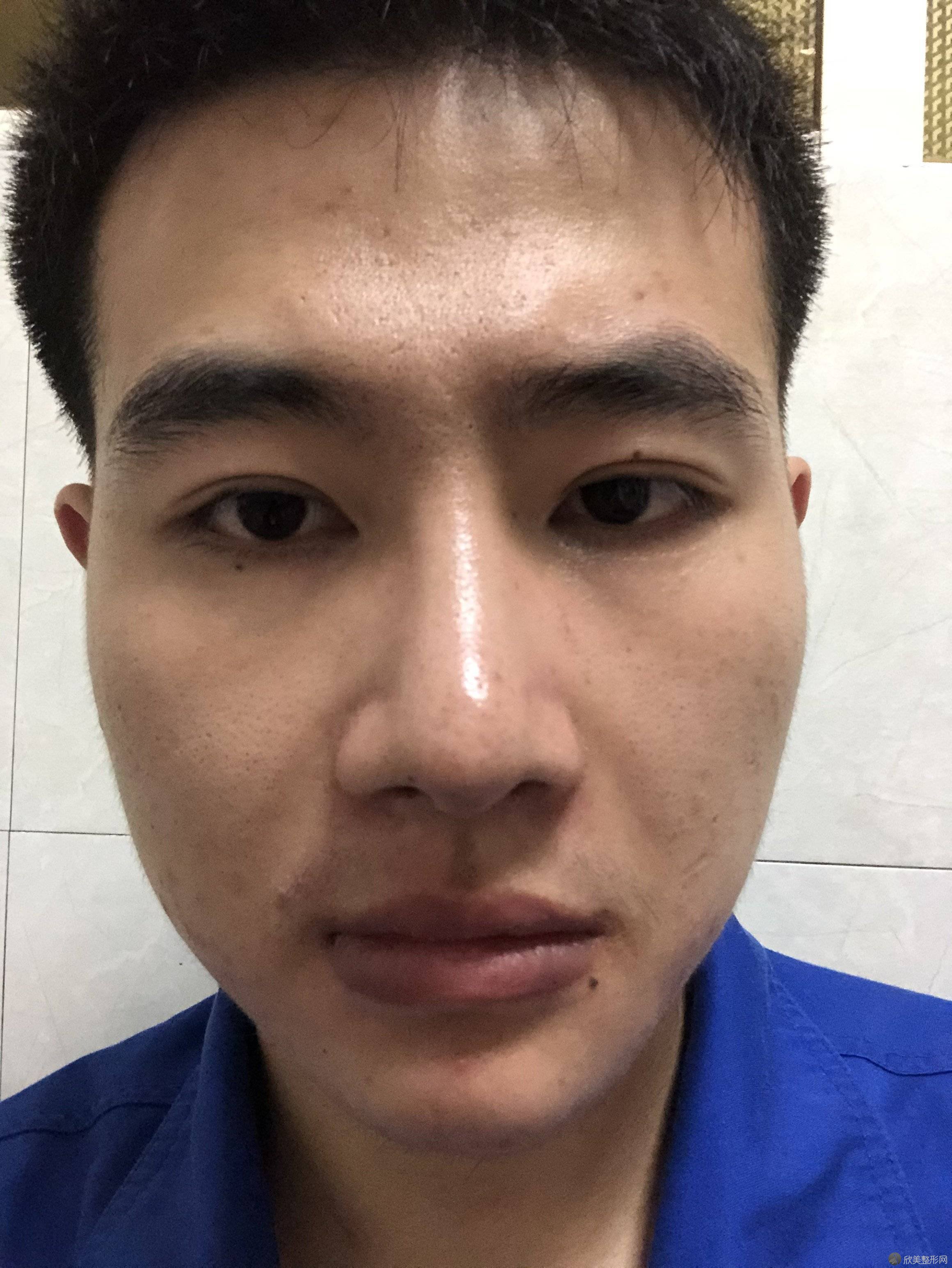 广州鼻修复：不明鼻背注射物修复术后一年随访 - 知乎