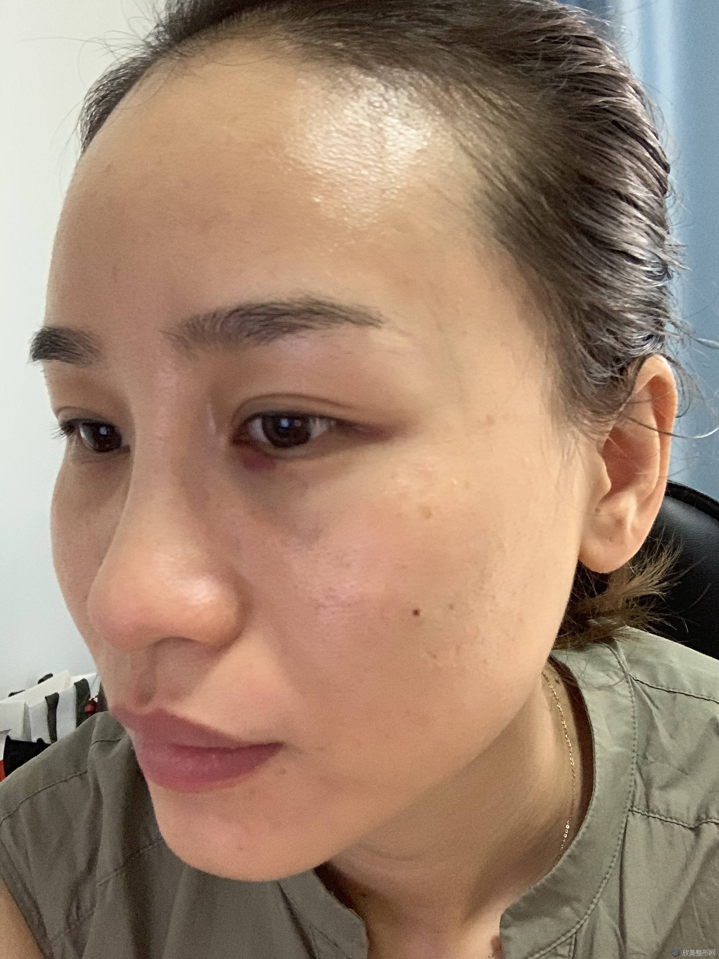 河南哪家医院做激光去眼袋靠谱？当属臻美、科技大学、妇幼保健院这三家!价